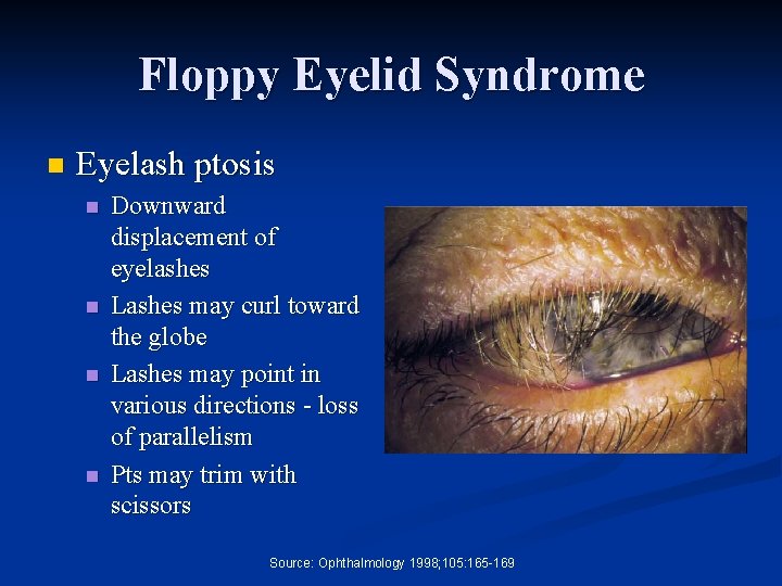 Floppy Eyelid Syndrome n Eyelash ptosis n n Downward displacement of eyelashes Lashes may