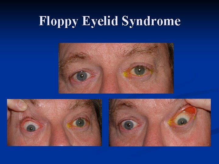 Floppy Eyelid Syndrome 
