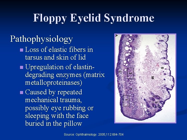 Floppy Eyelid Syndrome Pathophysiology Loss of elastic fibers in tarsus and skin of lid