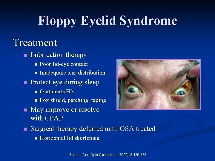 Floppy Eyelid Syndrome Treatment n Lubrication therapy n n n Protect eye during sleep
