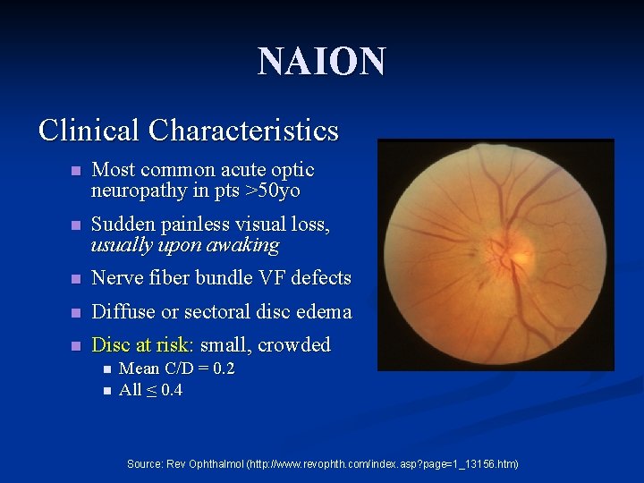 NAION Clinical Characteristics n Most common acute optic neuropathy in pts >50 yo n