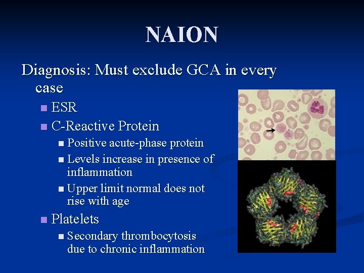 NAION Diagnosis: Must exclude GCA in every case ESR n C-Reactive Protein n n