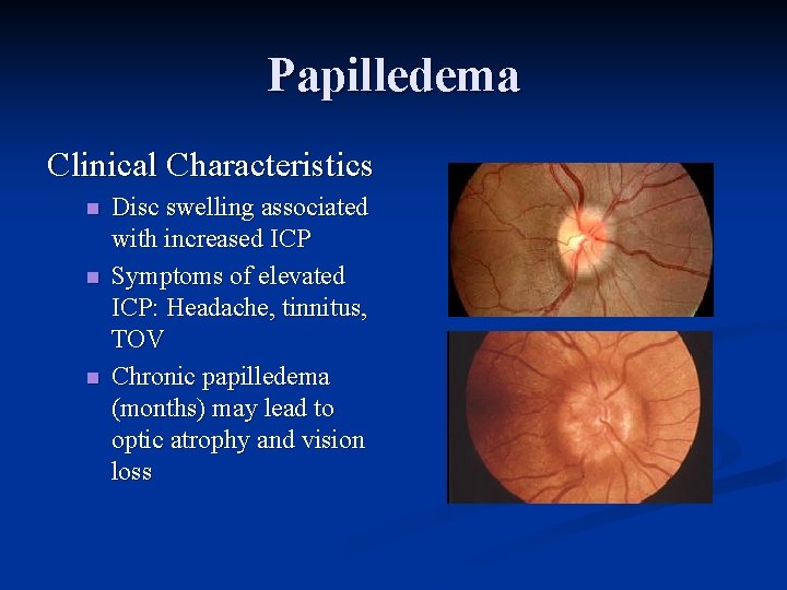 Papilledema Clinical Characteristics n n n Disc swelling associated with increased ICP Symptoms of