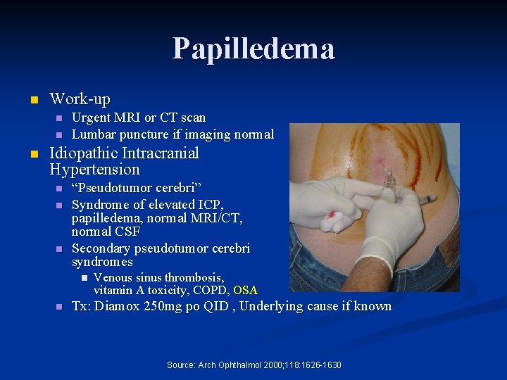 Papilledema n Work-up n n n Urgent MRI or CT scan Lumbar puncture if