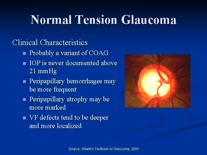 Normal Tension Glaucoma Clinical Characteristics n n n Probably a variant of COAG IOP