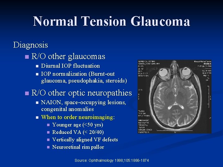 Normal Tension Glaucoma Diagnosis n R/O other glaucomas n n n Diurnal IOP fluctuation