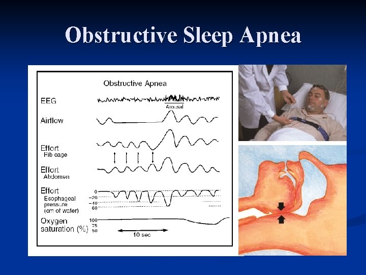 Obstructive Sleep Apnea 