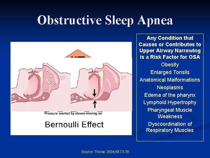 Obstructive Sleep Apnea Any Condition that Causes or Contributes to Upper Airway Narrowing is