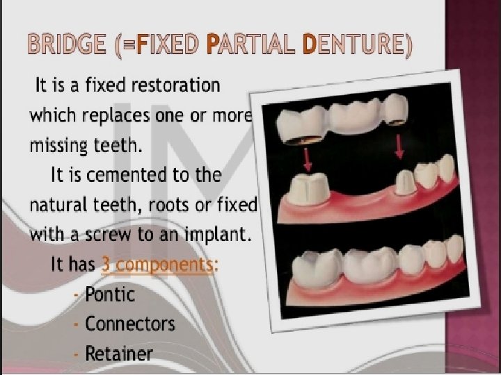 Bridge prostheses components pontic and abutment retainers 2