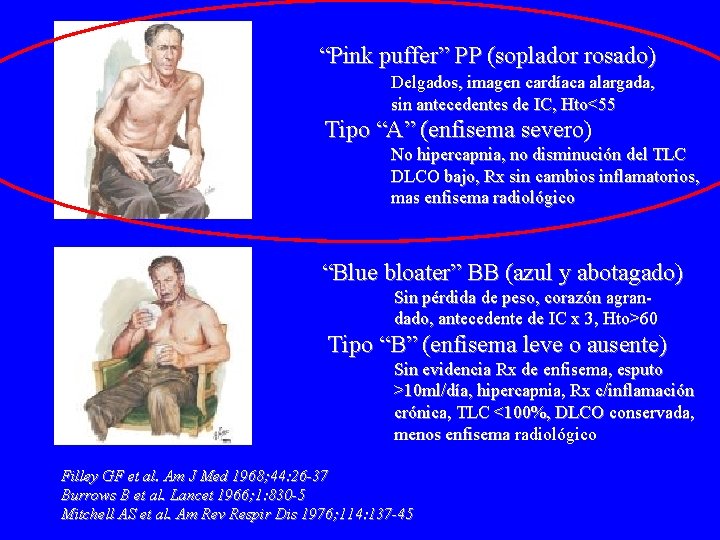 “Pink puffer” PP (soplador rosado) Delgados, imagen cardíaca alargada, sin antecedentes de IC, Hto<55