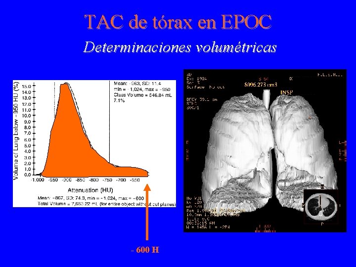 TAC de tórax en EPOC Determinaciones volumétricas - 600 H 