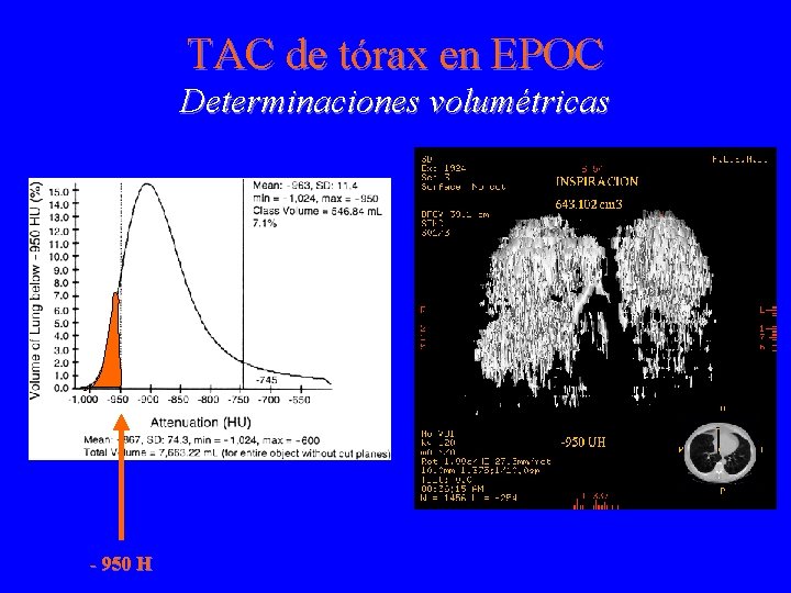 TAC de tórax en EPOC Determinaciones volumétricas - 950 H 