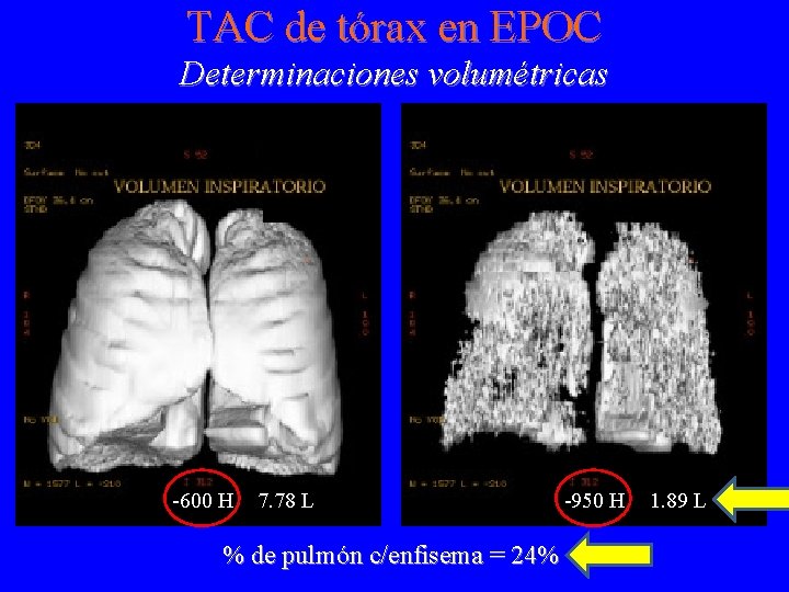 TAC de tórax en EPOC Determinaciones volumétricas -600 H 7. 78 L % de