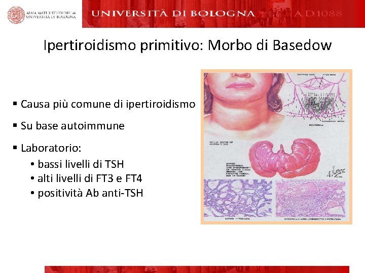 Ipertiroidismo primitivo: Morbo di Basedow § Causa più comune di ipertiroidismo § Su base