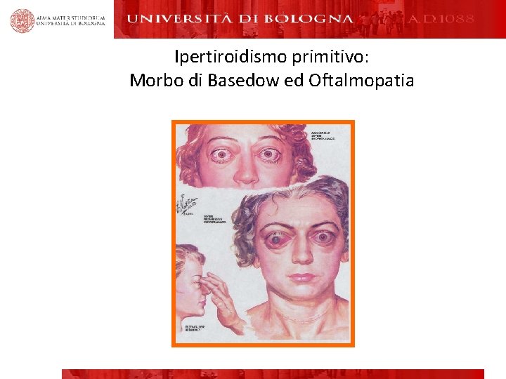 Ipertiroidismo primitivo: Morbo di Basedow ed Oftalmopatia 