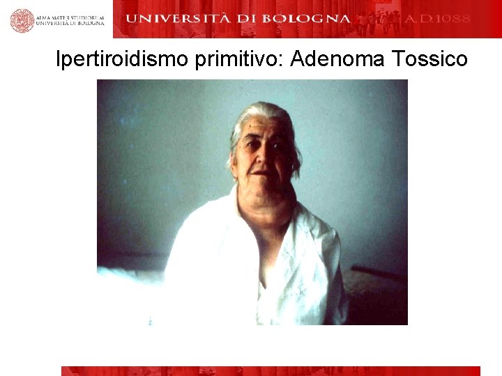 Ipertiroidismo primitivo: Adenoma Tossico 