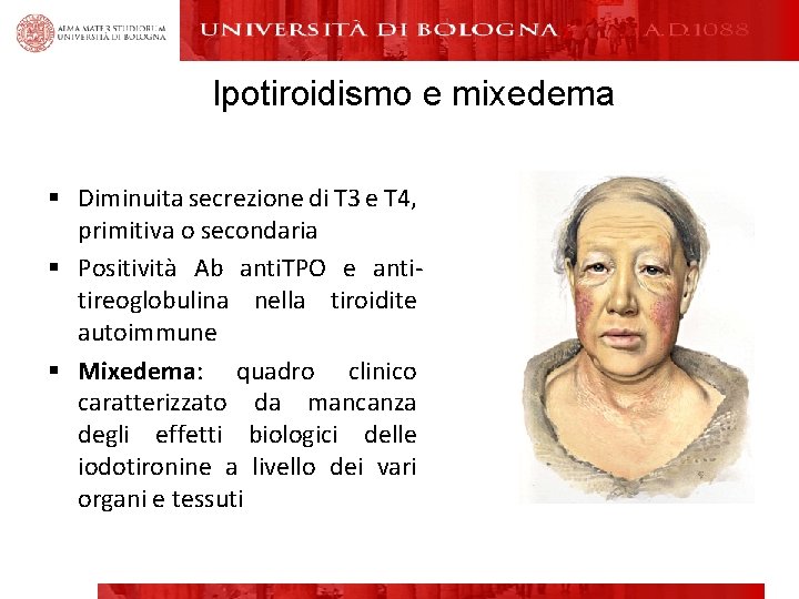 Ipotiroidismo e mixedema Alma Mater Studiorum Università di Bologna § Diminuita secrezione di T