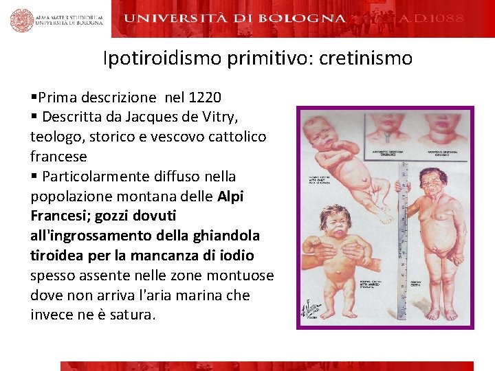 Ipotiroidismo primitivo: cretinismo §Prima descrizione nel 1220 § Descritta da Jacques de Vitry, teologo,