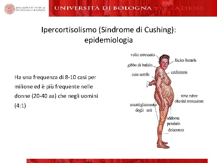 Ipercortisolismo (Sindrome di Cushing): epidemiologia Ha una frequenza di 8 -10 casi per milione