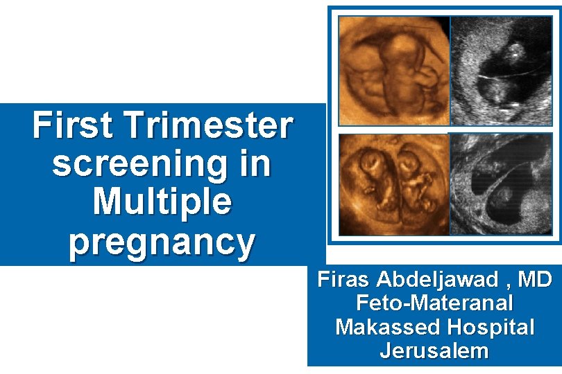 First Trimester screening in Multiple pregnancy Firas Abdeljawad , MD Feto-Materanal Makassed Hospital Jerusalem