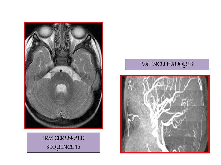 VX ENCEPHALIQUES IRM CEREBRALE SEQUENCE T 2 