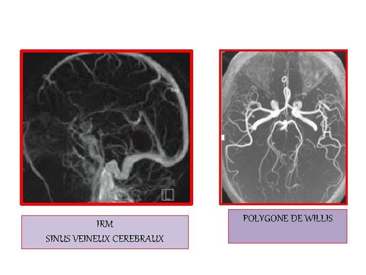 IRM SINUS VEINEUX CEREBRAUX POLYGONE DE WILLIS 