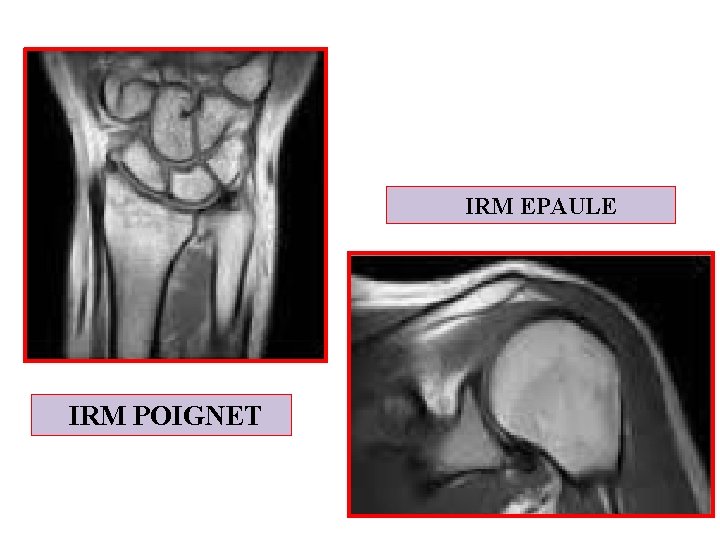 IRM EPAULE IRM POIGNET 
