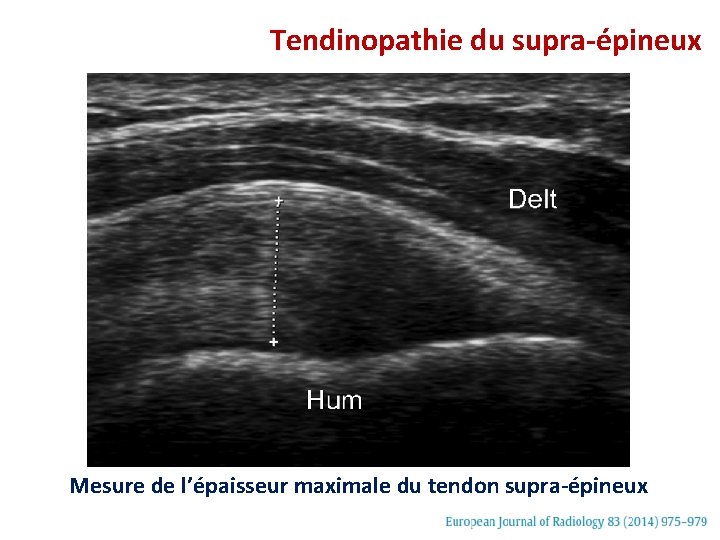 Tendinopathie du supra-épineux Mesure de l’épaisseur maximale du tendon supra-épineux 