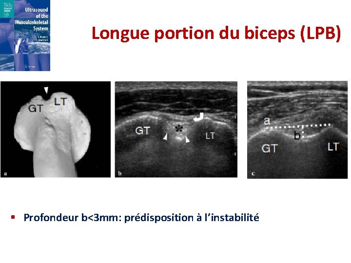 Longue portion du biceps (LPB) § Profondeur b<3 mm: prédisposition à l’instabilité 