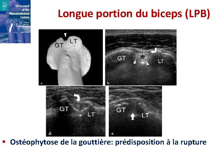 Longue portion du biceps (LPB) § Ostéophytose de la gouttière: prédisposition à la rupture