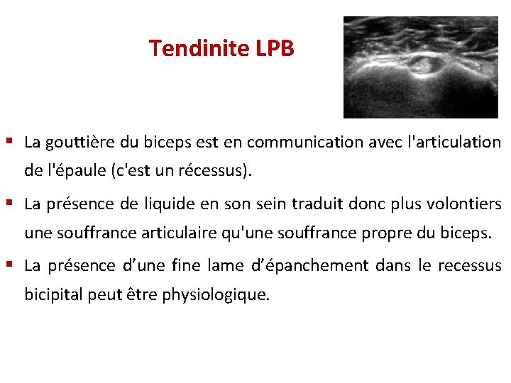 Tendinite LPB § La gouttière du biceps est en communication avec l'articulation de l'épaule