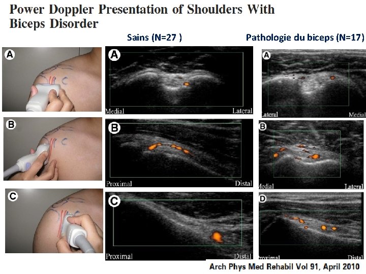 Sains (N=27 ) Pathologie du biceps (N=17) 