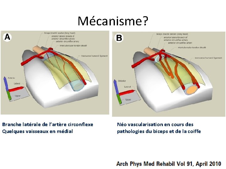 Mécanisme? Branche latérale de l’artère circonflexe Quelques vaisseaux en médial Néo vascularisation en cours