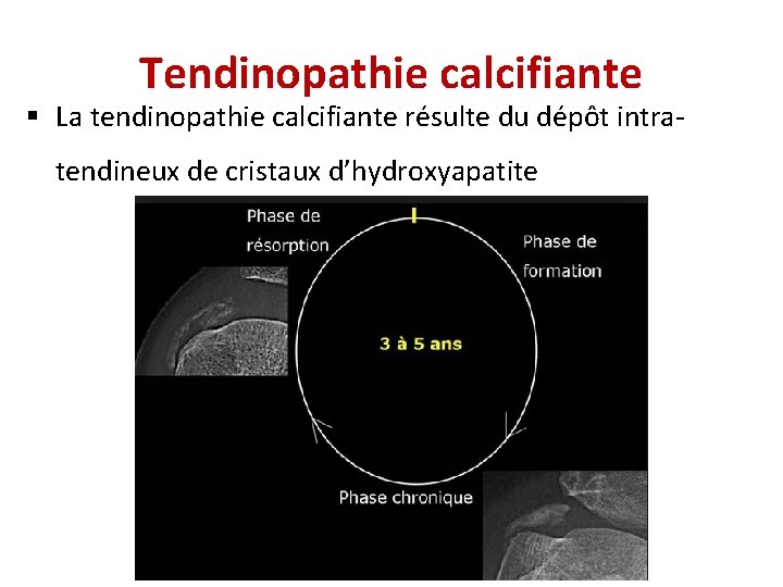 Tendinopathie calcifiante § La tendinopathie calcifiante résulte du dépôt intratendineux de cristaux d’hydroxyapatite 