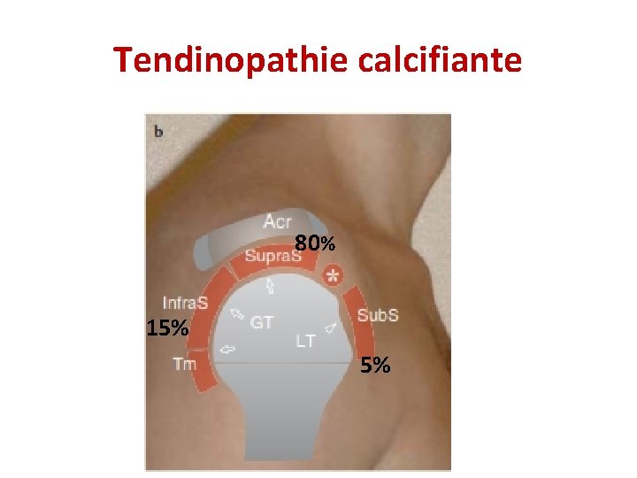 Tendinopathie calcifiante 80% 15% 5% 