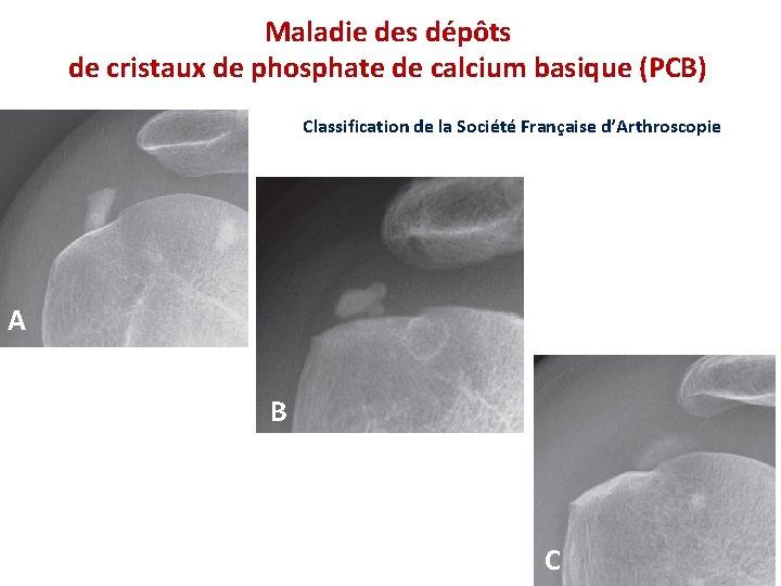 Maladie des dépôts de cristaux de phosphate de calcium basique (PCB) Classification de la