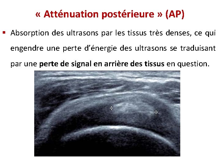  « Atténuation postérieure » (AP) § Absorption des ultrasons par les tissus très