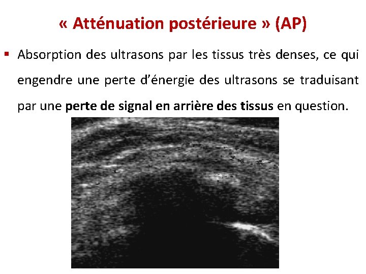  « Atténuation postérieure » (AP) § Absorption des ultrasons par les tissus très