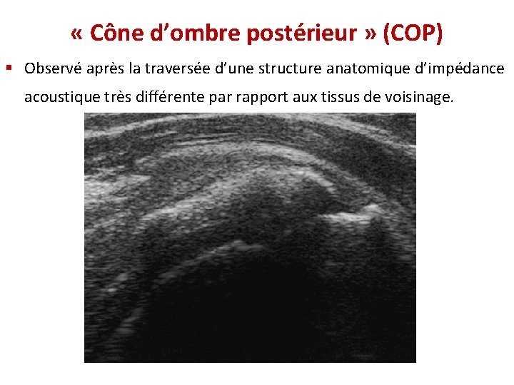  « Cône d’ombre postérieur » (COP) § Observé après la traversée d’une structure