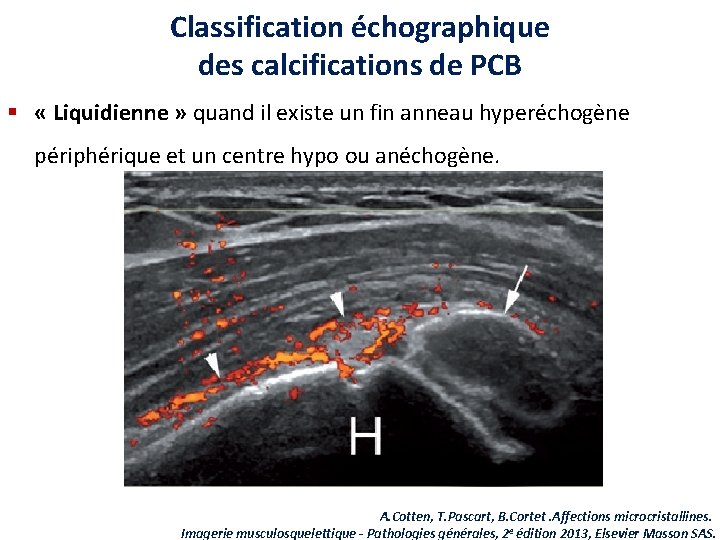 Classification échographique des calcifications de PCB § « Liquidienne » quand il existe un