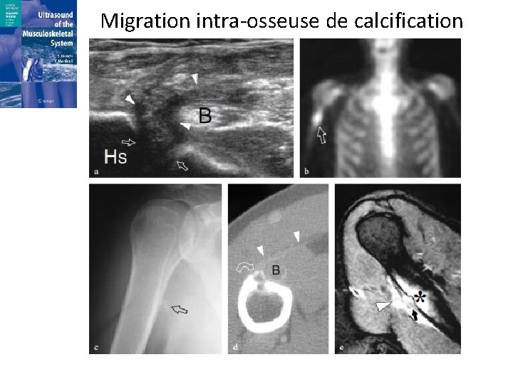 Migration intra-osseuse de calcification 