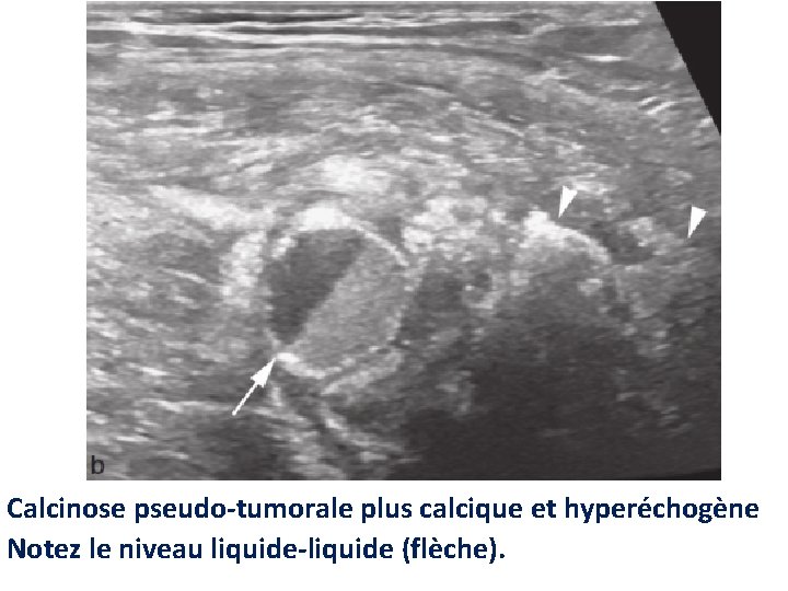 Calcinose pseudo-tumorale plus calcique et hyperéchogène Notez le niveau liquide-liquide (flèche). 