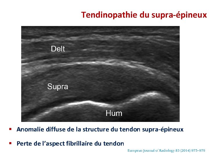 Tendinopathie du supra-épineux § Anomalie diffuse de la structure du tendon supra-épineux § Perte