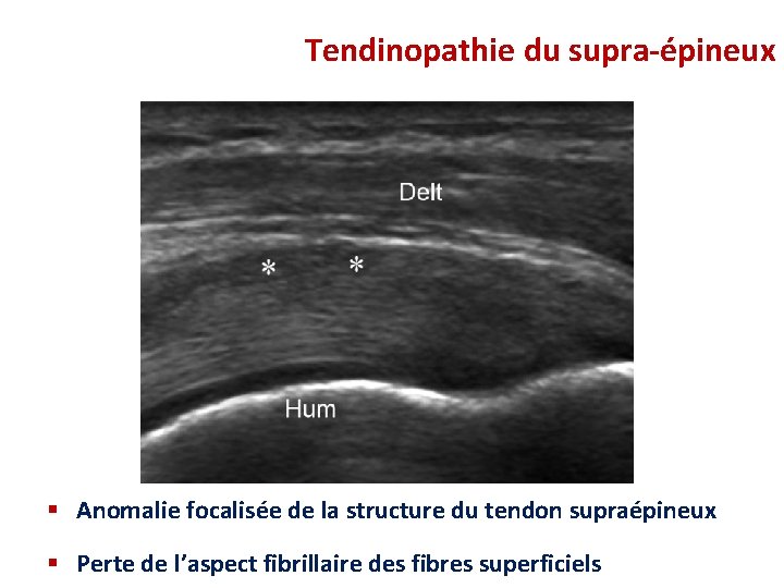 Tendinopathie du supra-épineux § Anomalie focalisée de la structure du tendon supraépineux § Perte