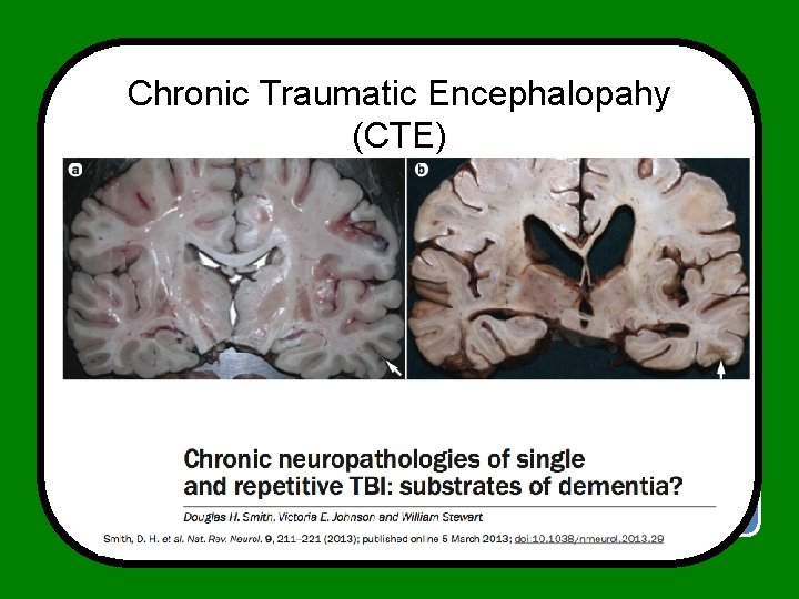 Chronic Traumatic Encephalopahy (CTE) Axonal Damage Concussion Neurotransmitter release + hyperexcitation Cell death 