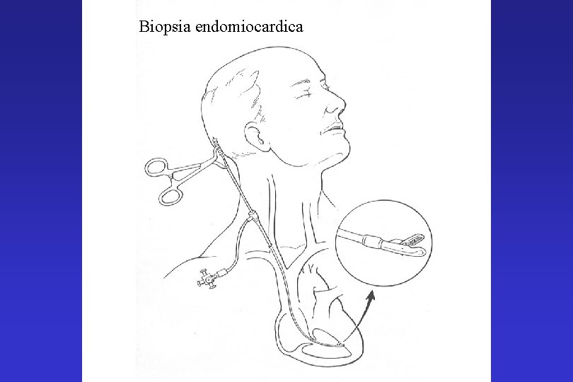 Biopsia endomiocardica 