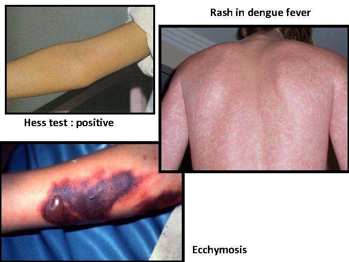 Rash in dengue fever Hess test : positive Ecchymosis 