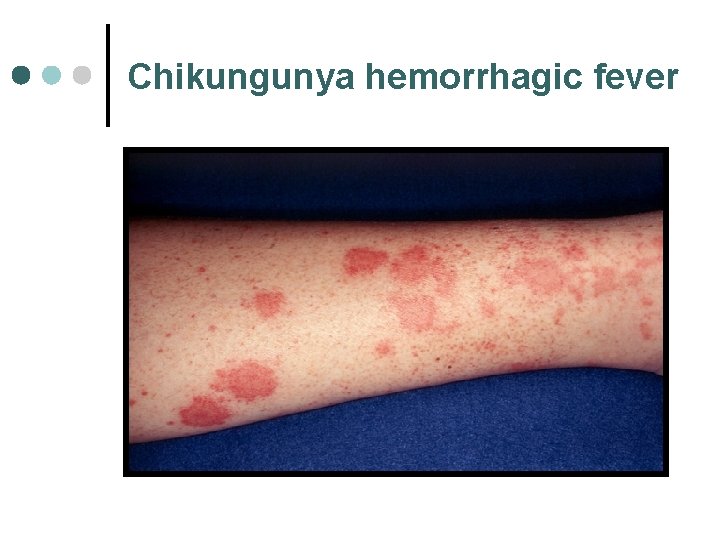 Chikungunya hemorrhagic fever 