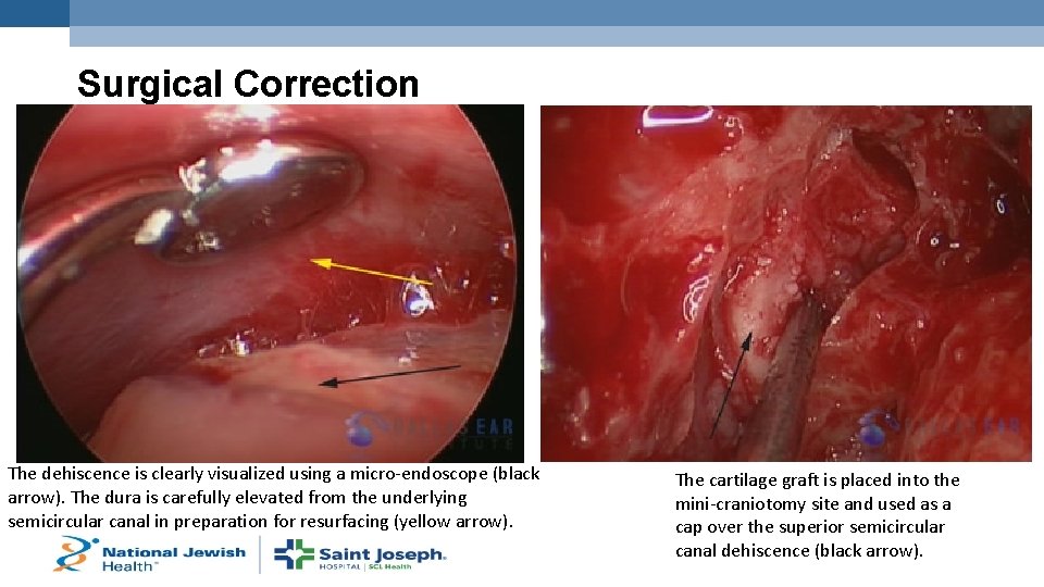 Surgical Correction The dehiscence is clearly visualized using a micro-endoscope (black arrow). The dura