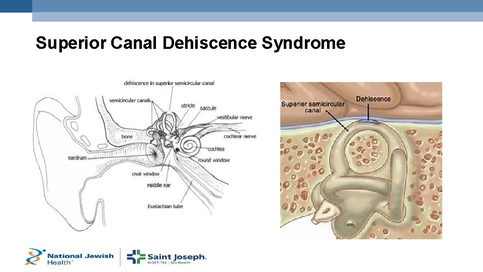 Superior Canal Dehiscence Syndrome 